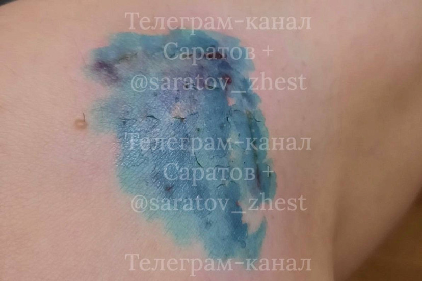 Бродячая собака прокусила ногу саратовчанке: возбуждено дело о халатности
